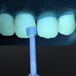 Icon Resin Infiltration (1 tooth)